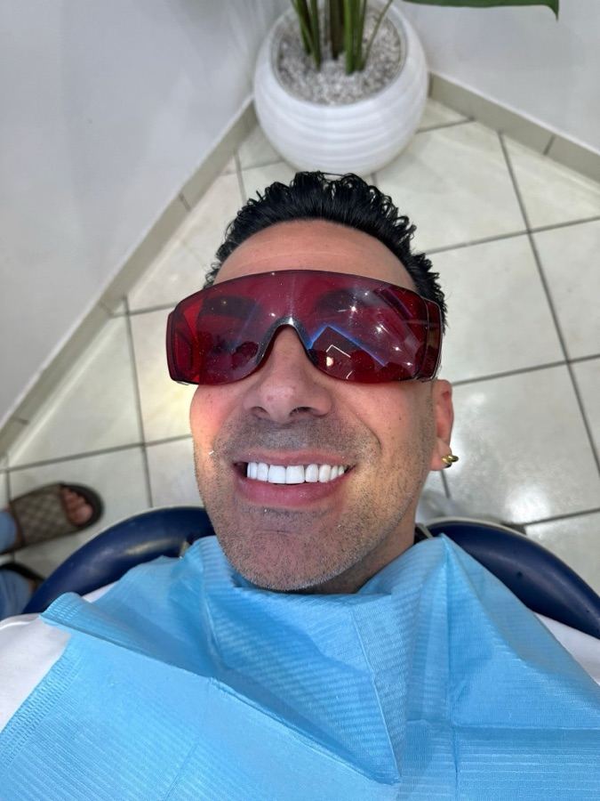 After dental veneers Marrakech natural result