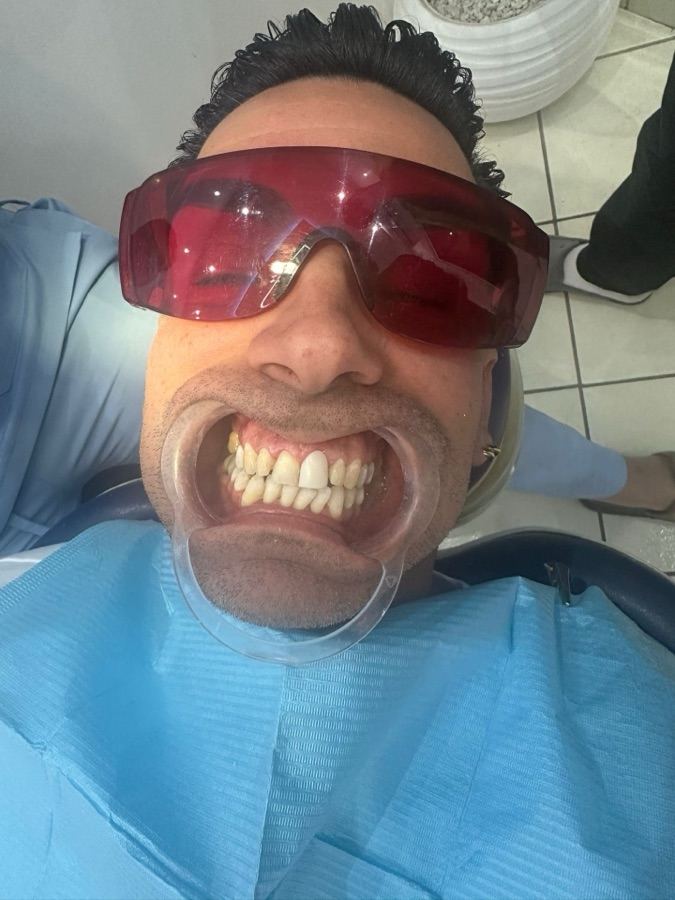 Before dental veneer treatment Marrakech